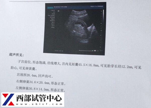 試管促排卵用彩超的好處是什么
