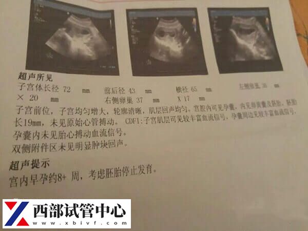 試管怎么預(yù)防胎停育