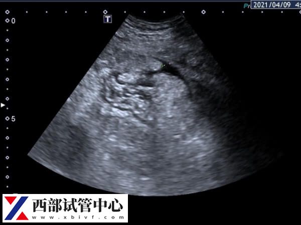 取卵后肚子脹大概率是腹水