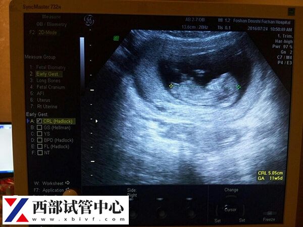 試管嬰兒進周期前要做b超檢查