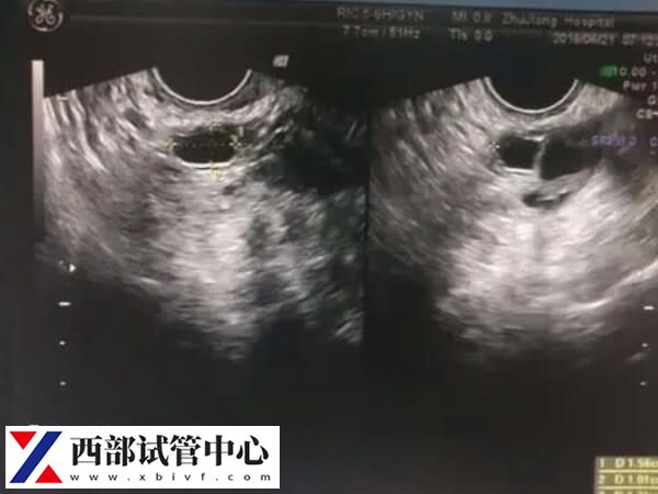 監(jiān)測(cè)排卵可以找到排卵期